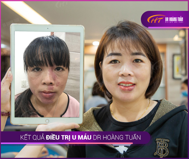 Kết quả trị u máu - bớt máu